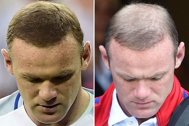 2回の植毛も効果なし イングランド代表のルーニーがユーロ16敗退のショックでハゲに 植毛前と比べてみた サッカーコラム Footwall フットウォール